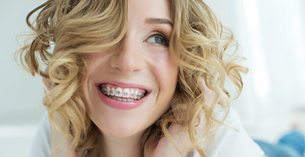 How long do you need braces | Straight Orthodontics