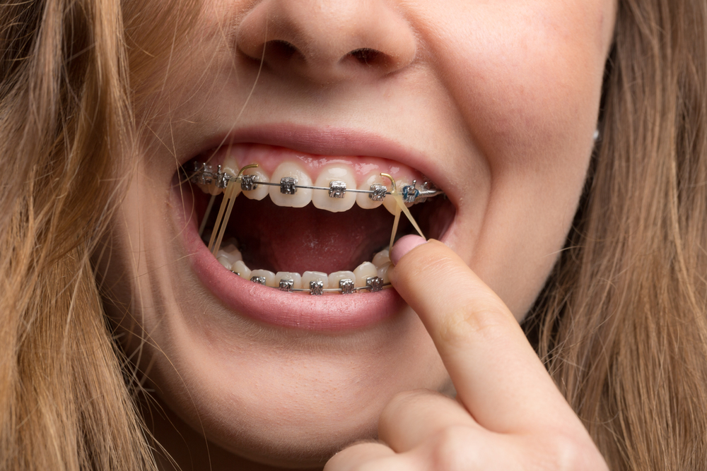 Why use rubber bands with braces Straight Orthodontics Mentone
