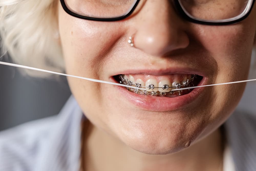 Lake Basin Orthodontic Centre - There are 4 Types of Braces